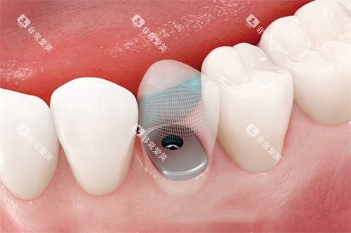 种植牙完成后透视 种植牙完成后透视