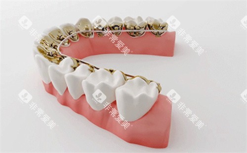 牙齿矫正模型 牙齿矫正模型