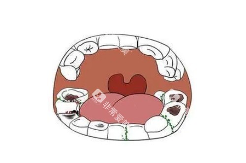 牙齿蛀牙问题卡通图 牙齿蛀牙问题卡通图