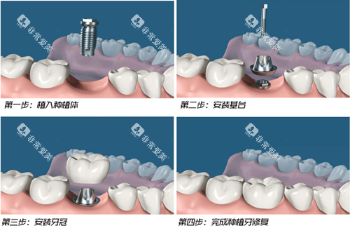 种植牙过程图示 种植牙过程图示