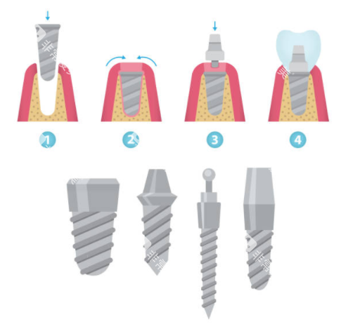 种植牙详解图 种植牙详解图