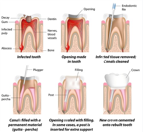 根管治疗过程图 根管治疗过程图