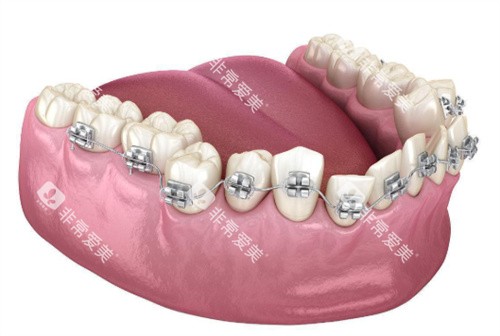 金属矫正牙齿动画示意图 金属矫正牙齿动画示意图