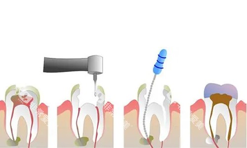 根管治疗过程的示意图