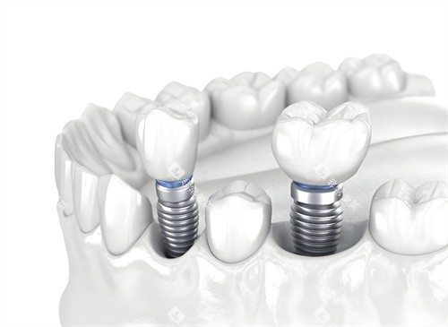 种植牙图片模型