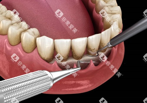 牙周刮治外部图