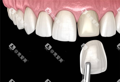 单颗牙齿贴面图 单颗牙齿贴面图