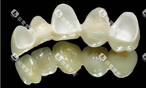 牙冠全瓷牙材料示意图