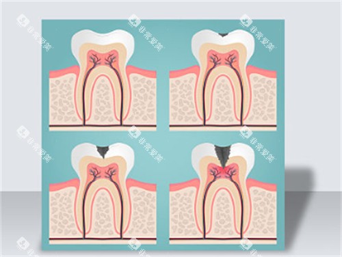 不保护牙齿的危害