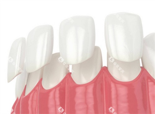 牙齿贴面动画展示图