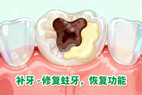 牙齿蛀牙修复展示图