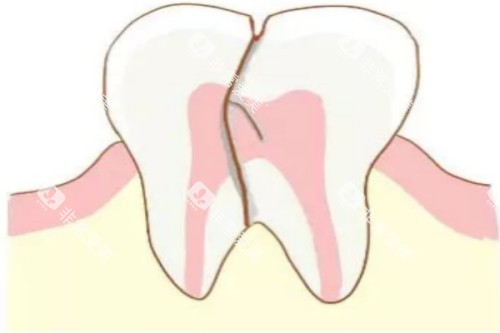 牙齿隐裂卡通图