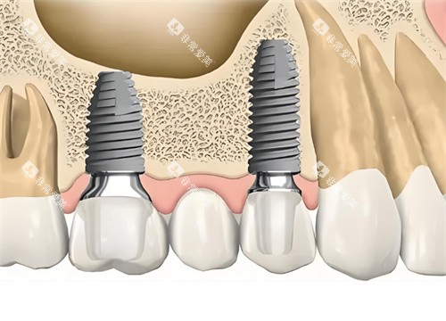 种植牙解剖图片