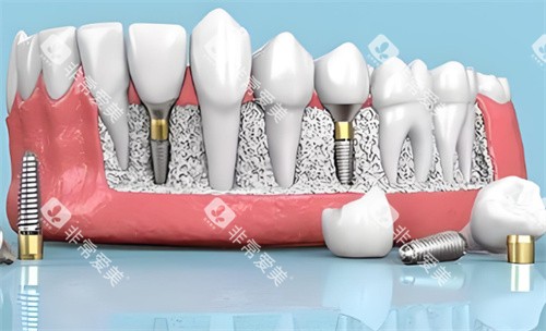 种植牙材料动画展示 种植牙材料动画展示