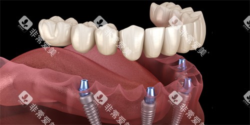 半口种植牙图示 半口种植牙图示