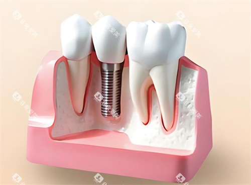种植牙模型解剖展示