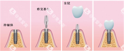 种植牙过程漫画图