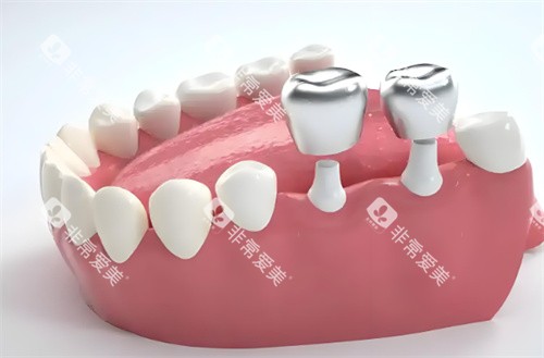 种植牙示意图片
