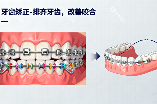 金属牙齿矫正卡通展示图