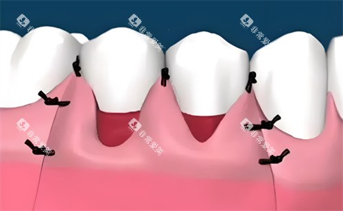 牙龈萎缩治疗 牙龈萎缩治疗