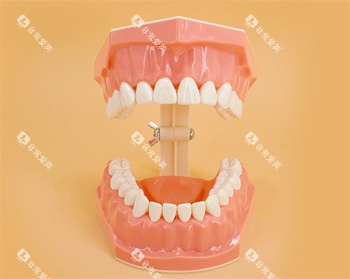 牙齿开口模型 牙齿开口模型