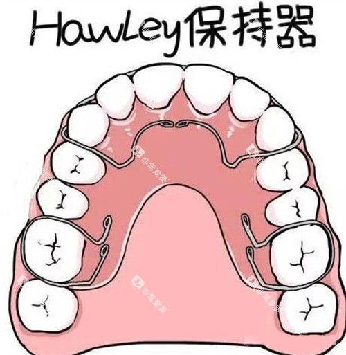 牙齿矫正Hawley哈雷保持器