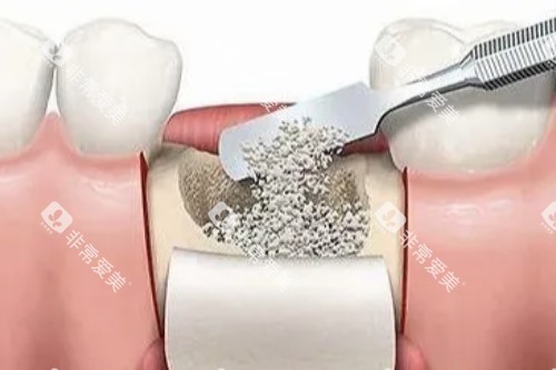 种植牙植骨图片展示 种植牙植骨图片展示