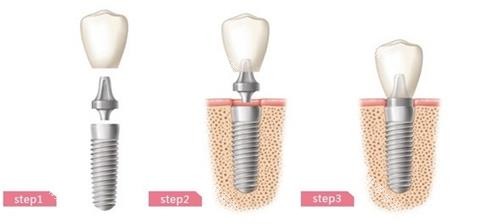 种植牙的步骤。 种植牙的步骤。