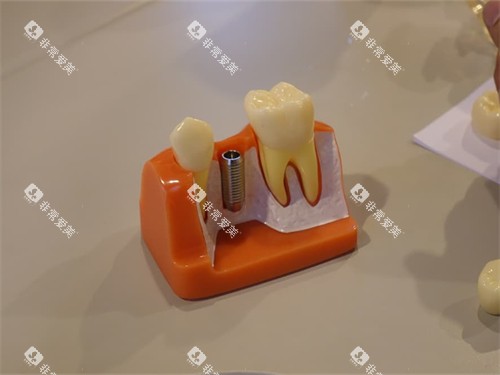种植牙植体和牙齿模型图 种植牙植体和牙齿模型图