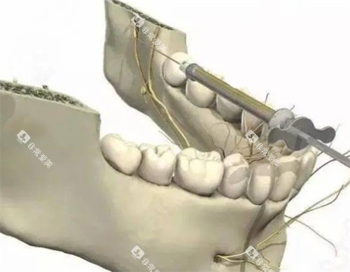 牙周韧带内注射麻醉的入针点 牙周韧带内注射麻醉的入针点