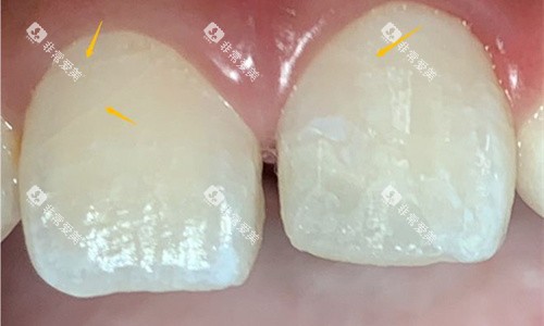 门牙隐裂展示图 门牙隐裂展示图