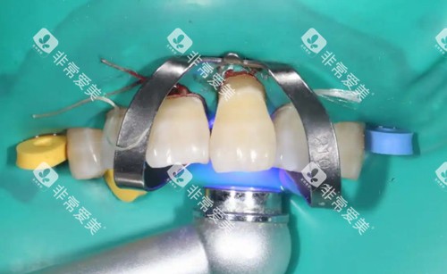 种植牙手术细节图 种植牙手术细节图
