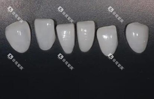 牙齿贴面修复改善 牙齿贴面修复改善