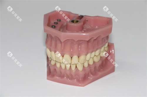 牙齿模型示意图