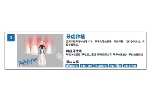 蓝天口腔种植牙优势图 蓝天口腔种植牙优势图