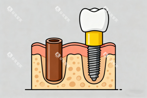 单颗种植牙卡通图展示 单颗种植牙卡通图展示