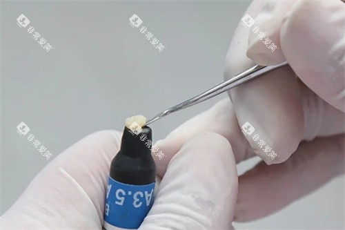 医生取补牙树脂 医生取补牙树脂