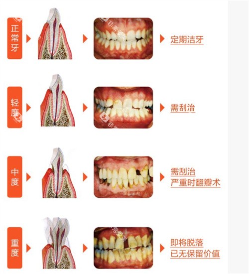 牙周病治疗流程