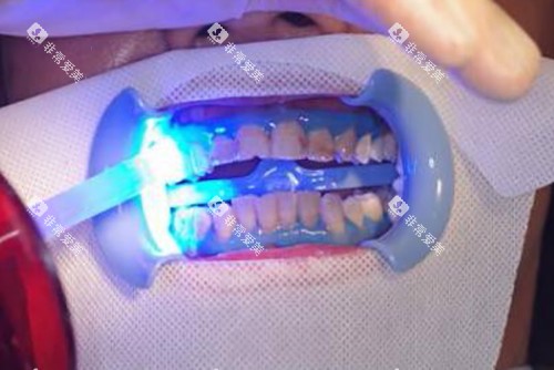 冷光美白示意图 冷光美白示意图