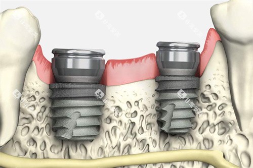 韩国多普勒种植牙植入模拟图