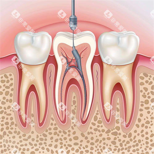 牙齿根管治疗牙髓问题漫画图 牙齿根管治疗牙髓问题漫画图