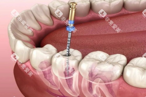 根管治疗卡通图片展示