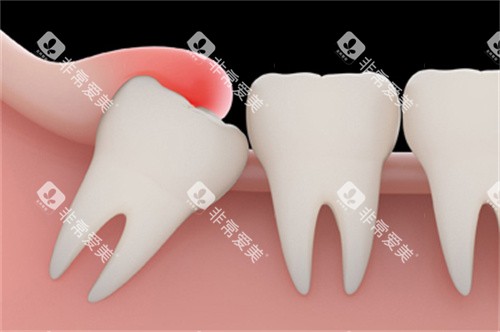 智齿萌出牙龈红肿 智齿萌出牙龈红肿