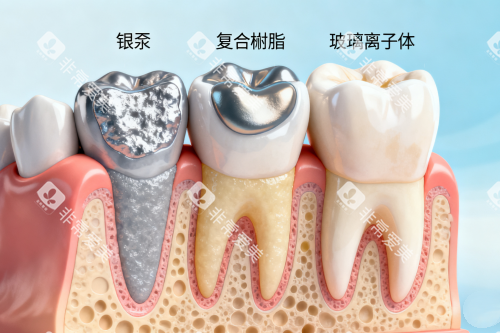 各类型补牙材料卡通图 各类型补牙材料卡通图