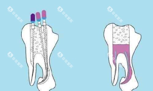 根管治疗手术示意图 根管治疗手术示意图