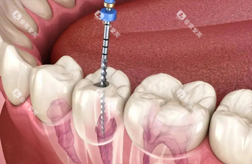 根管治疗动画透视图 根管治疗动画透视图