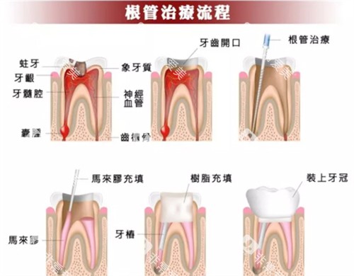 根管治疗流程