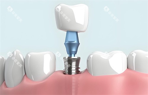 种植牙模型结构图片 种植牙模型结构图片