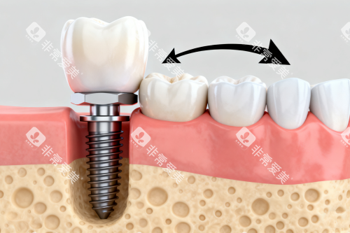 种植体与正常牙齿对比图