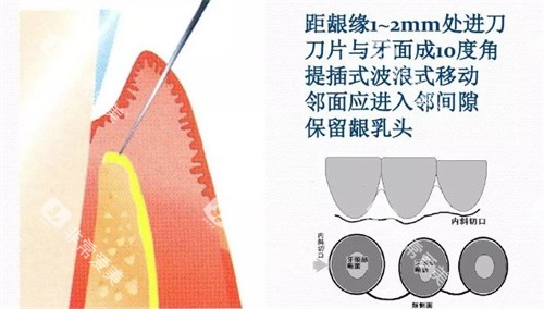 牙周炎翻瓣手术全切口